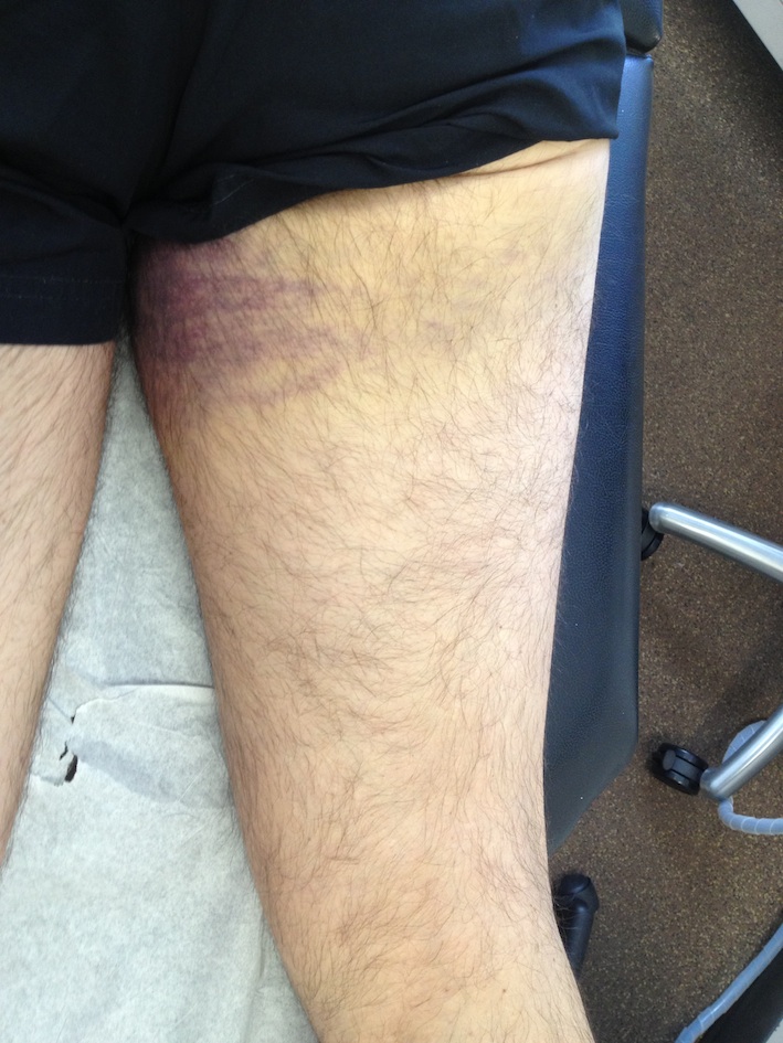 Proximal Hamstring Rupture Bruise
